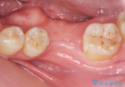 インプラントによる咬合機能回復の治療中