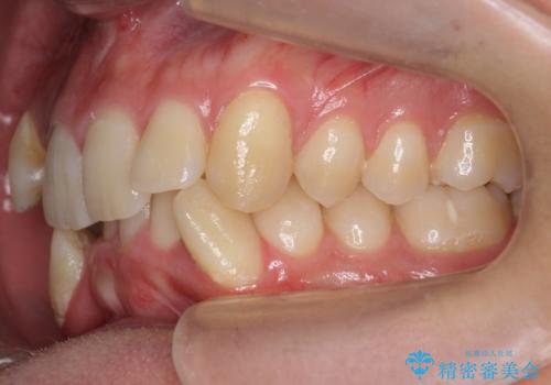 前歯のがたつき 下の八重歯の治療前