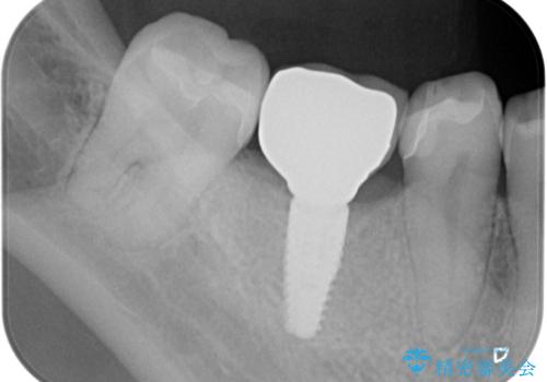 失った歯のインプラント補綴の治療後