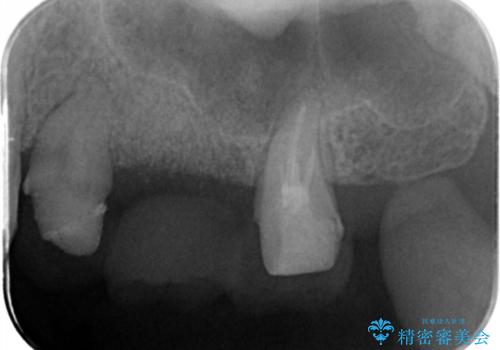 歯槽堤保存を行ったブリッジ治療の治療中