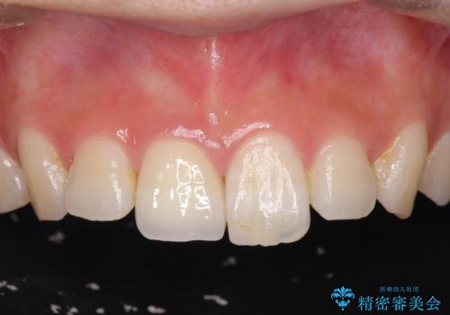 [ 前歯のセラミック治療 ]  変色した前歯を綺麗にしたいの症例 治療後