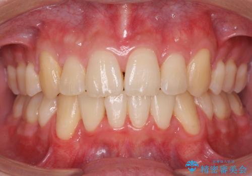 前歯のがたつき　下の八重歯の症例 治療後