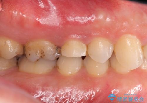 強い咬合力クリアランスの問題を解決したメタルボンドブリッジ治療の治療前