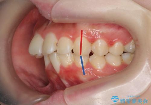 [ 出っ歯を治したい ]　マイクロインプラントを用いた大きな後方移動の治療前