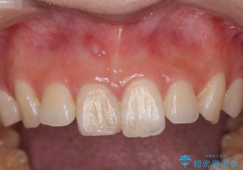 [ 前歯のセラミック治療 ]  変色した前歯を綺麗にしたいの治療前