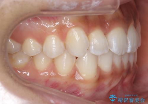 前歯のがたつき 1年かからず治療 マウスピース矯正の治療後