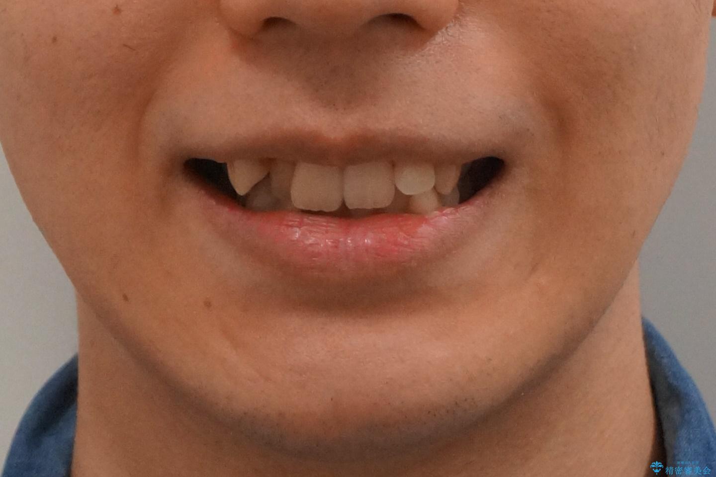 前歯のがたつき　下の八重歯の治療前（顔貌）