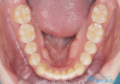前歯が隠れていて見えない クロスバイトの矯正治療の治療後