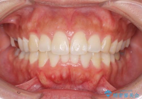 前歯の角度を改善するマウスピース矯正の症例 治療後