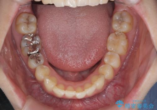 [ 出っ歯を治したい ]　マイクロインプラントを用いた大きな後方移動の治療後