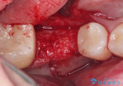 失った歯のインプラント補綴の治療中