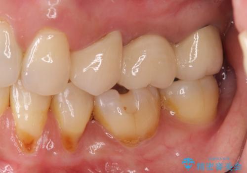 歯槽堤保存を行ったブリッジ治療の治療後