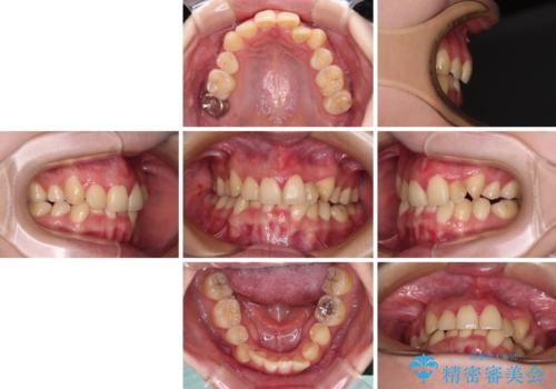 【モニター】再矯正でデコボコの前歯を改善 抜歯矯正の後戻りの治療前