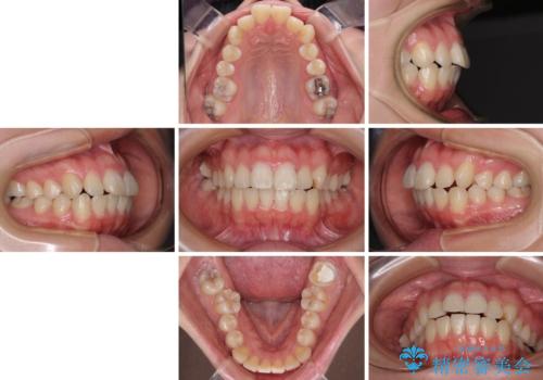 口元の突出感を抜歯矯正で改善 メタル装置で費用を抑えるの治療前