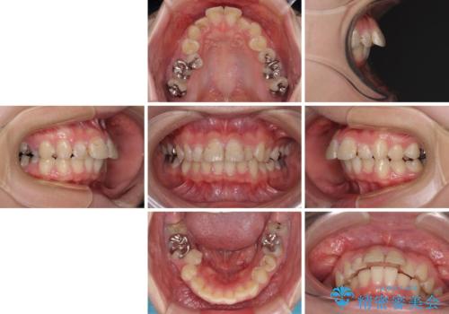 前に飛び出した前歯を治したい ワイヤー装置による抜歯矯正治療の治療前