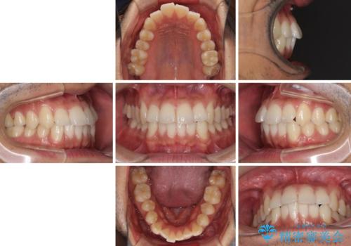 前歯のデコボコを治したい インビザライン矯正治療の治療前