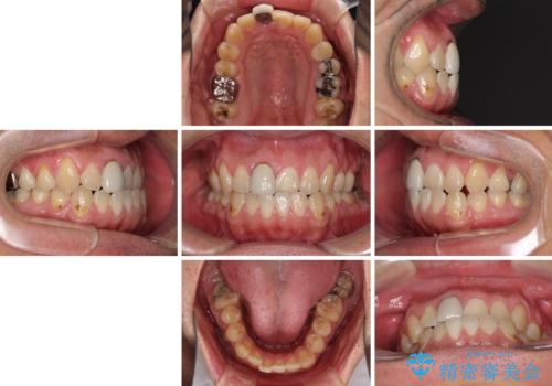 前歯のデコボコとクロスバイトをインビザライン矯正で改善の治療前