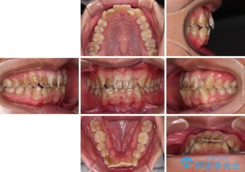 前歯のデコボコを費用を抑えたメタルブラケットできれいにの治療前