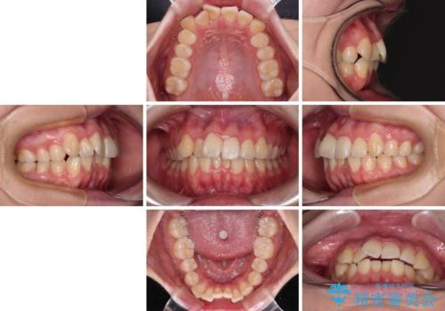 【モニター】八重歯を片側の抜歯矯正で治す メタルブラケット装置の治療前