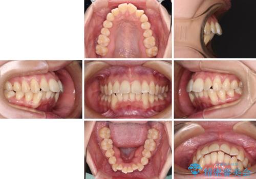 閉じにくい口元を抜歯矯正ですっきりとの治療前