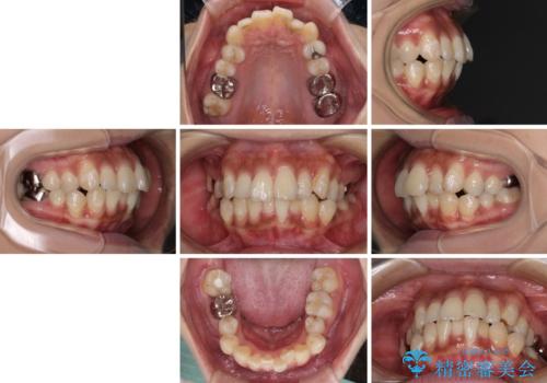 ワイヤー装置の抜歯矯正で横顔の口元の印象をすっきりとの治療前