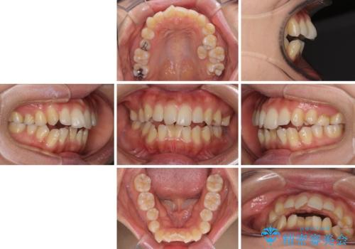 残存乳歯とオープンバイト インビザラインによる矯正治療の治療前