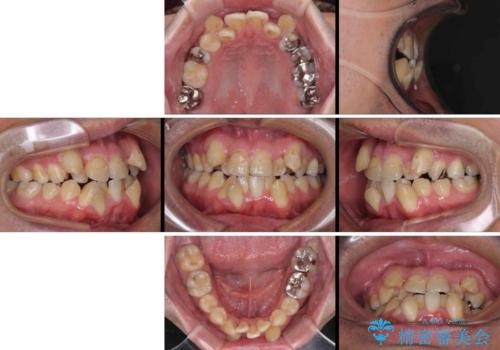 デコボコを治したい　八重歯の抜歯矯正の治療前