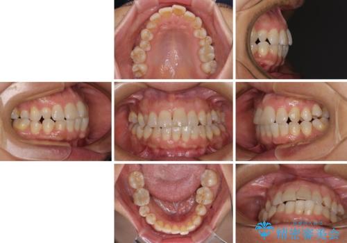 骨格のずれをカムフラージュ クロスバイトのワイヤー矯正の治療前