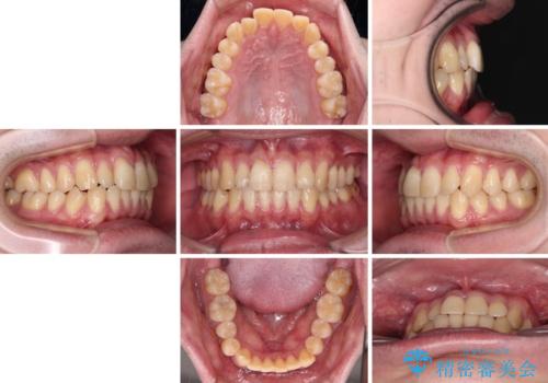 【モニター】前歯のデコボコとクロスバイト ワイヤー矯正で短期間に仕上げるの治療前