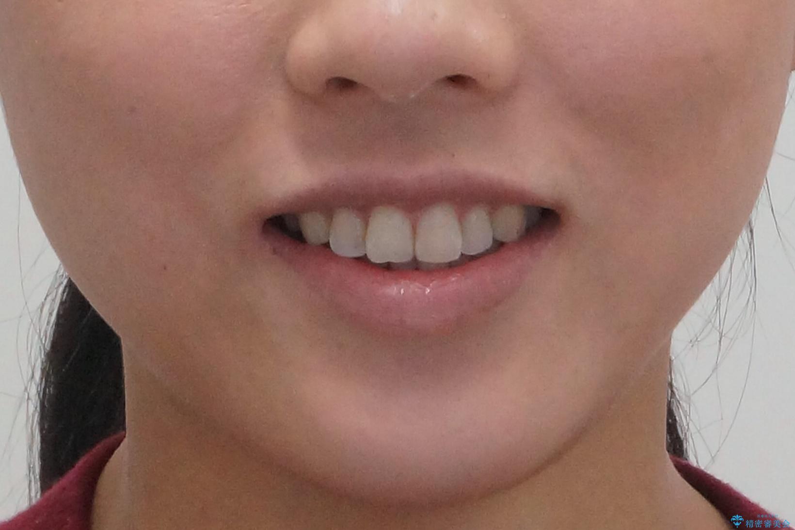 下の前歯のがたつき　インビザラインでの治療前（顔貌）