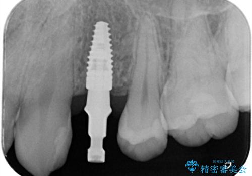 【インプラント】歯が無いので入れて欲しい!の治療中