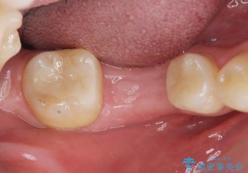 失った歯のインプラント補綴の治療前
