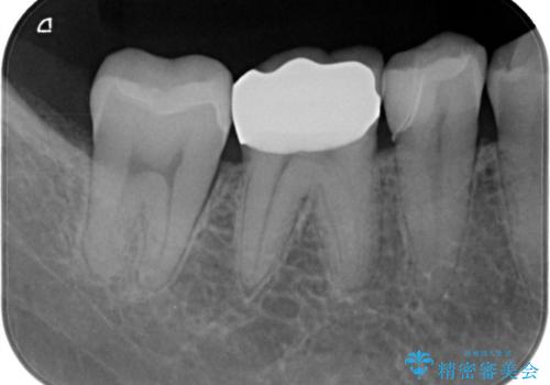 歯と歯の間によくものが詰まる。。セラミック治療の治療後