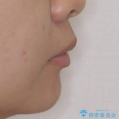 前に飛び出した前歯を治したい ワイヤー装置による抜歯矯正治療の治療前(顔貌)
