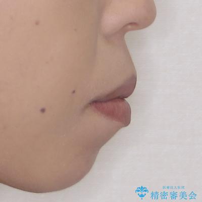 ワイヤー装置の抜歯矯正で横顔の口元の印象をすっきりとの治療前(顔貌)