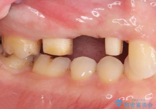強い咬合力クリアランスの問題を解決したメタルボンドブリッジ治療の治療中