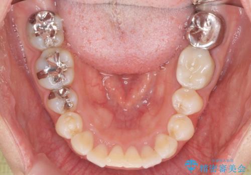 前歯の角度を改善するマウスピース矯正の治療後