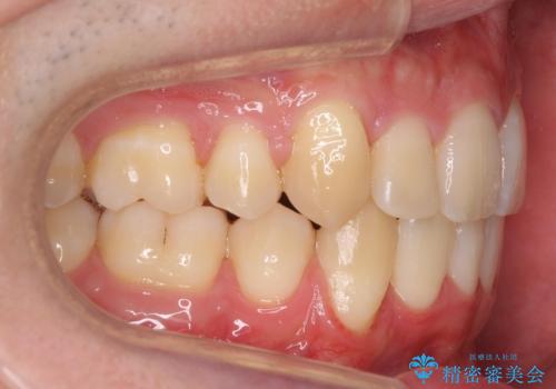 前歯のがたつき 下の八重歯の治療後