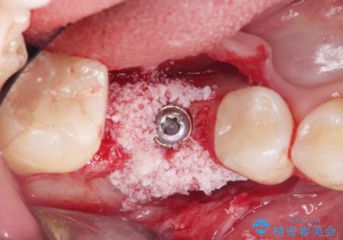 失った歯のインプラント補綴の治療中