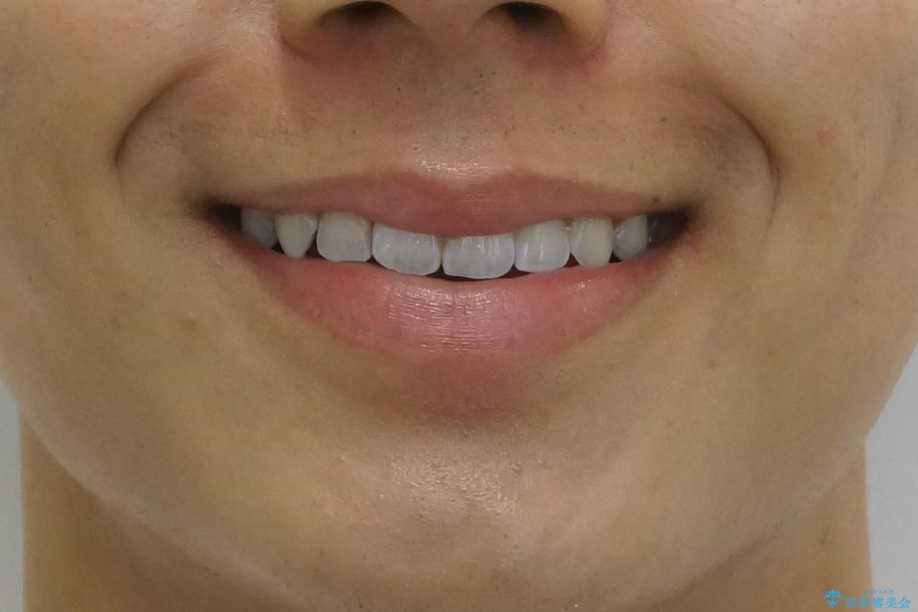 前歯のがたつき　1年かからず治療　マウスピース矯正の治療後（顔貌）