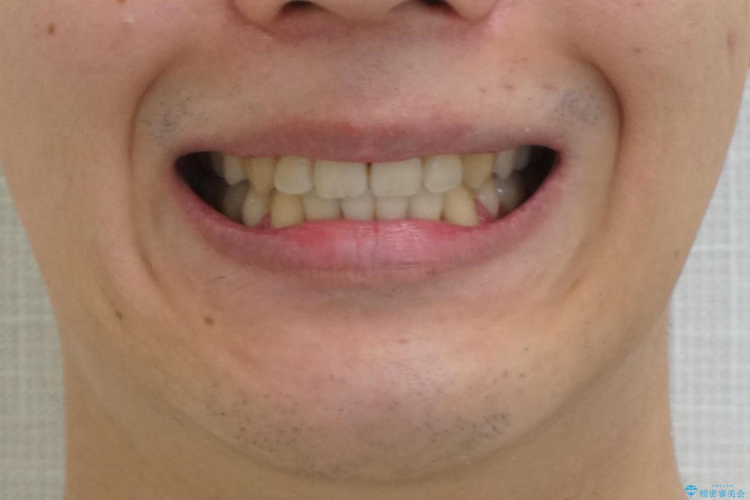 前歯のがたつき　下の八重歯の治療後（顔貌）