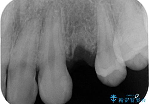 【インプラント】歯が無いので入れて欲しい!の治療中
