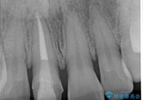 前歯の色が気になる オールセラミッククラウン(SP)の治療前