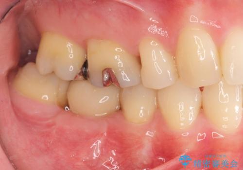 失った歯のインプラント補綴の治療後