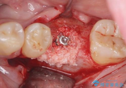 インプラントによる咬合機能回復の治療中