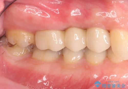 強い咬合力クリアランスの問題を解決したメタルボンドブリッジ治療の治療後