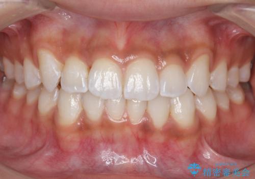 前歯のがたつき　1年かからず治療　マウスピース矯正の症例 治療後