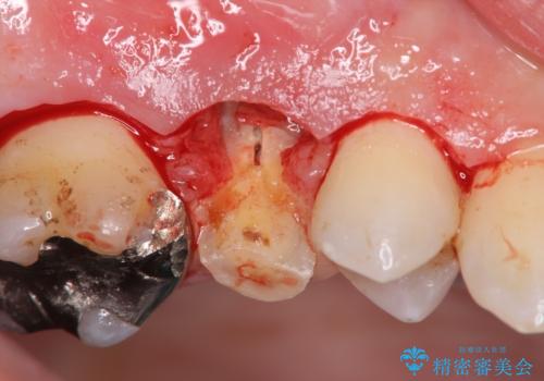 強い咬合力クリアランスの問題を解決したメタルボンドブリッジ治療の治療前