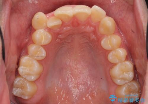 前歯のがたつき 下の八重歯の治療前