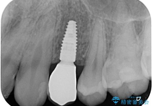 【インプラント】歯が無いので入れて欲しい!の治療後